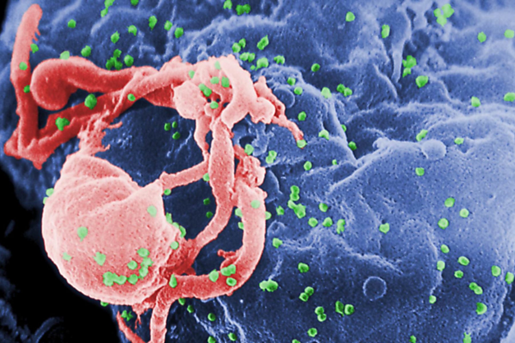 Scanning electron micrograph (SEM) of HIV-1 virions as green round bumps budding from the surface of a cultured lymphocyte cell.