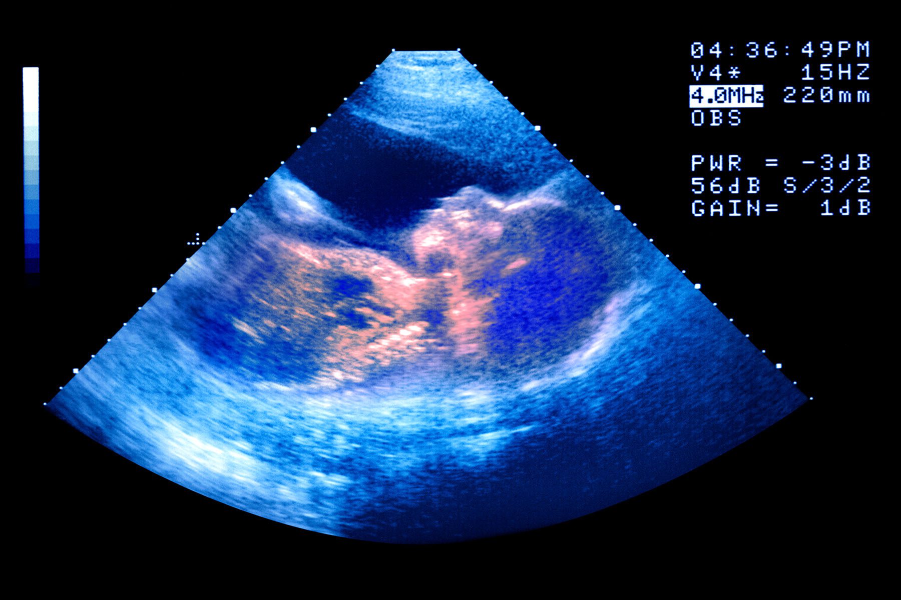 Image of an ultrasound of a baby