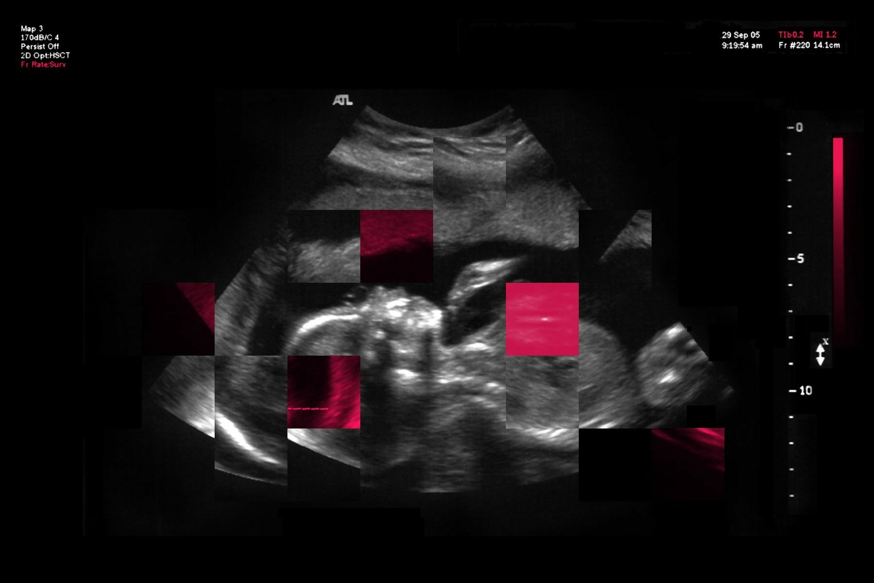 A photo of a sonogram that has distortion on it.