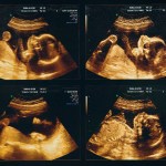 Four ultrasounds of a 24 week old fetus
