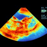 A photo illustration of a sonogram with a thermal map color gradient.