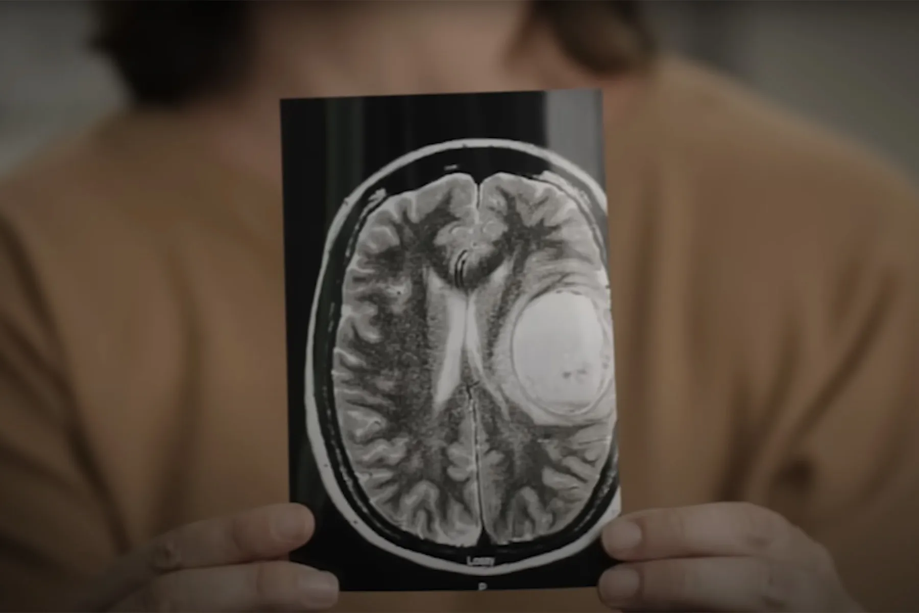 Primer plano de Caroline sosteniendo una resonancia magnética de un cerebro con un tumor visible.